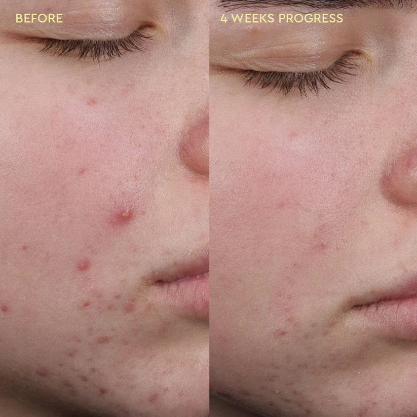 Blemish Clearing Cleanser