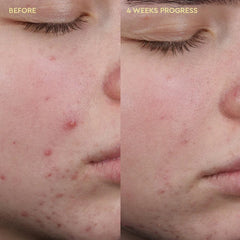 Blemish Clearing Cleanser