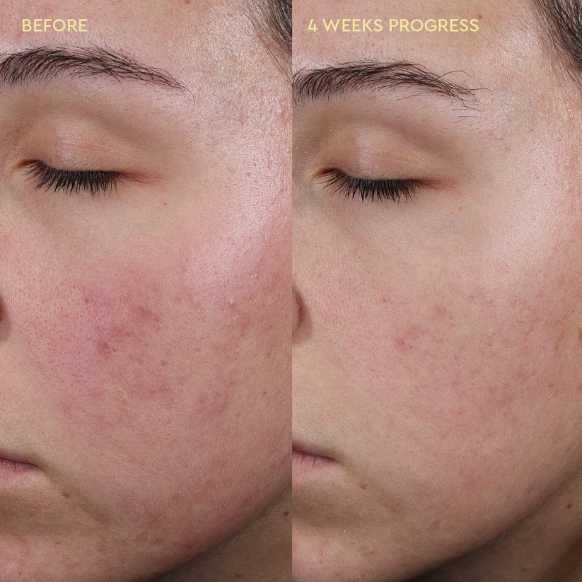 Blemish Control Moisturiser