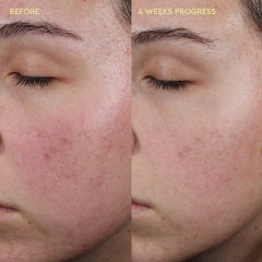 Blemish Control Moisturiser